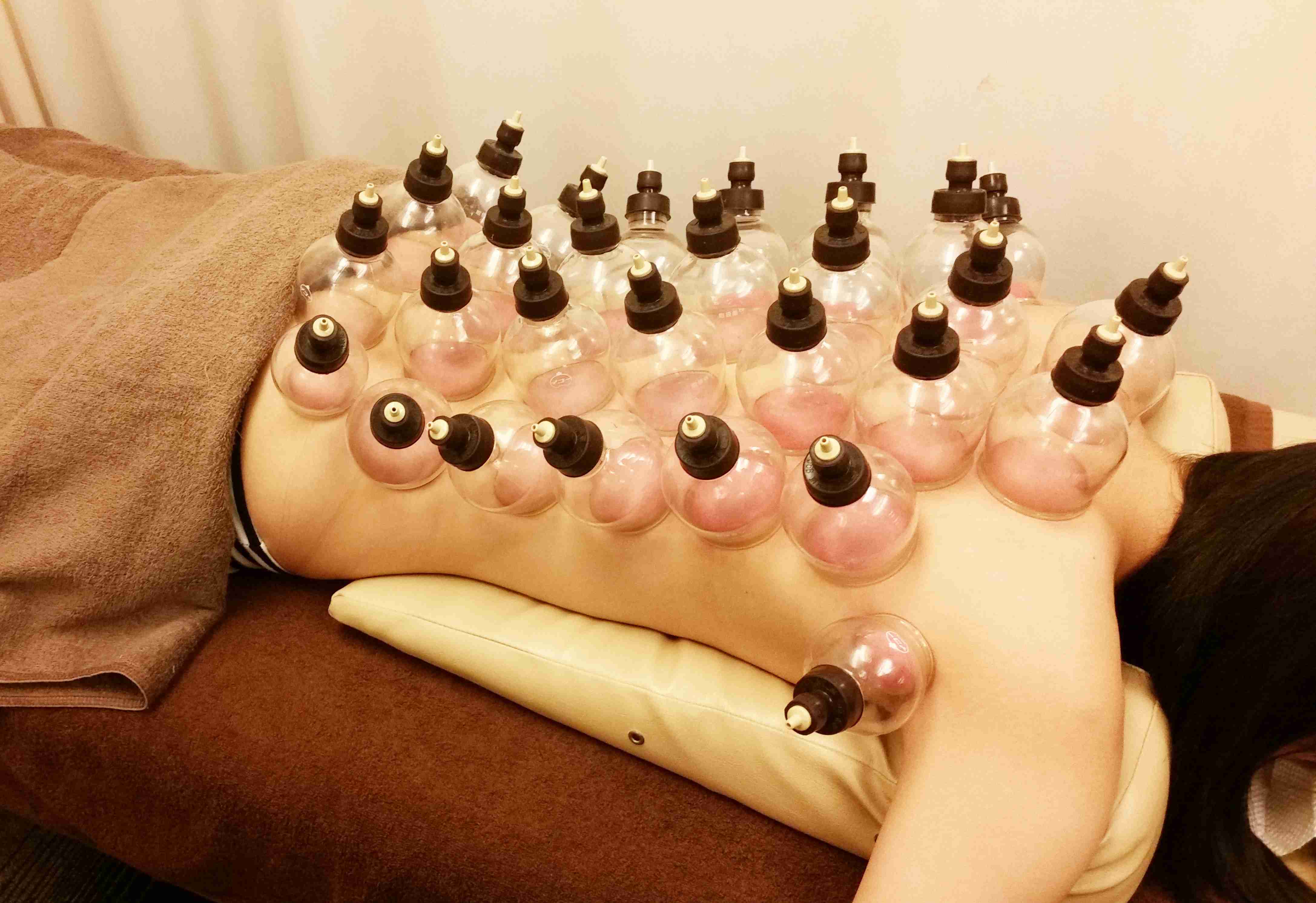 カッピング療法ってどうですか？
