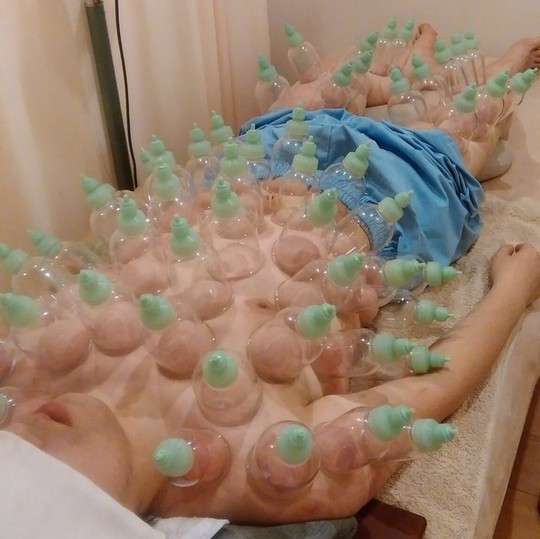 カッピング療法ってどうですか？