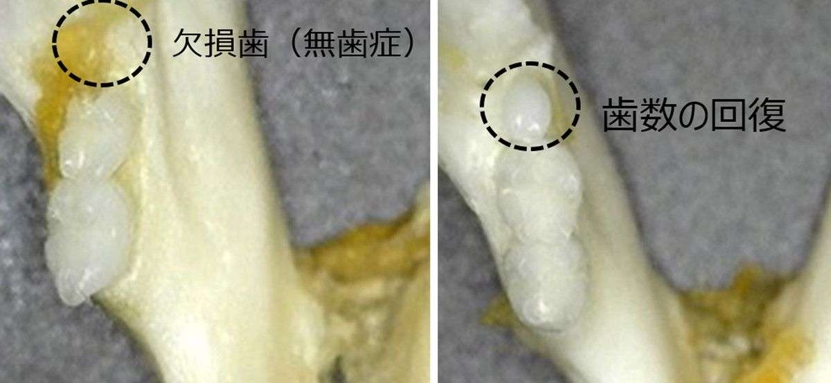 「歯生え薬」の治験、9月から開始へ＝2030年の実用化目指す―北野病院など