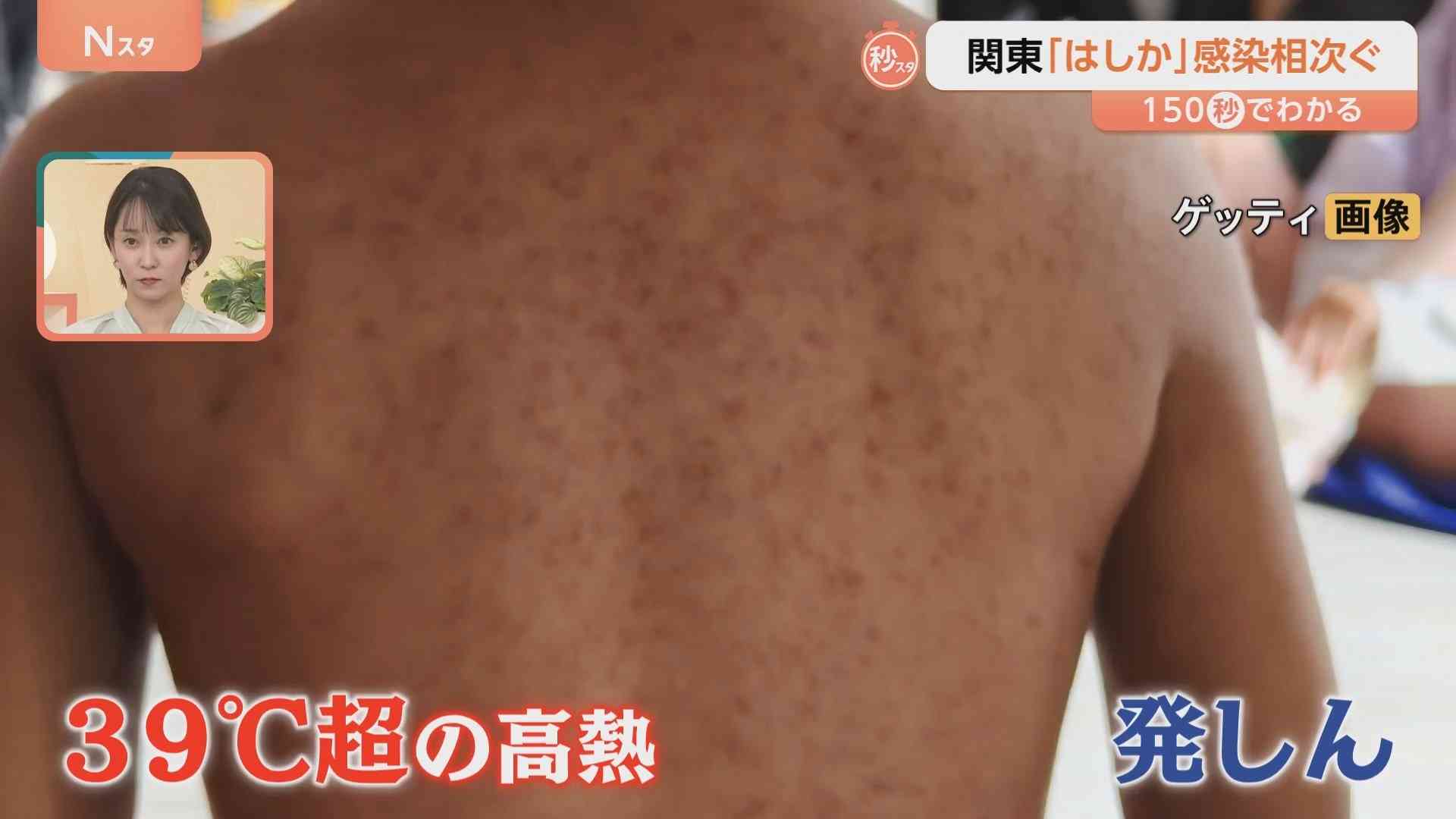 極めて感染力が強い「はしか」関東で報告相次ぐ　感染すると免疫がリセットされることも【Nスタ解説】　（TBS NEWS DIG Powered by JNN） - Yahoo!ニュース