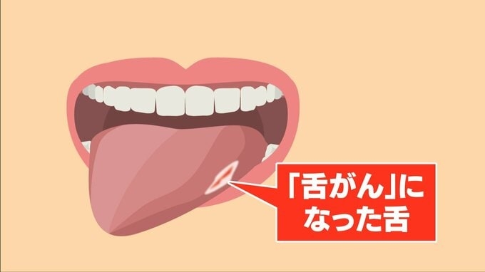 20年で2倍…増える若年層の「舌がん」 現代人特有の “狭い歯並び” が引き金に? 口内炎との決定的な違いとは