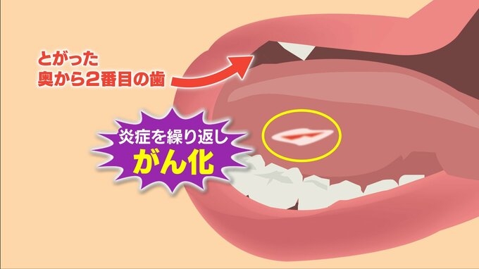 20年で2倍…増える若年層の「舌がん」 現代人特有の “狭い歯並び” が引き金に? 口内炎との決定的な違いとは