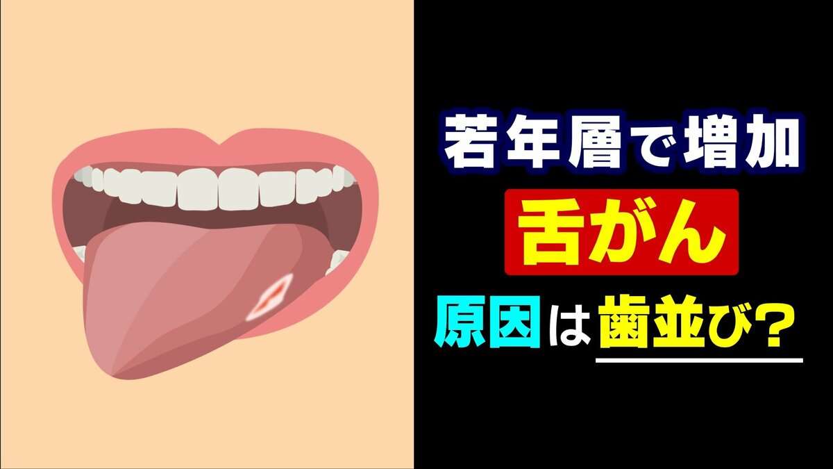 20年で倍増…増える若年層の「舌がん」 現代人特有の “狭い歯並び” が引き金に？ 口内炎との決定的な違いとは | TBS NEWS DIG (1ページ)