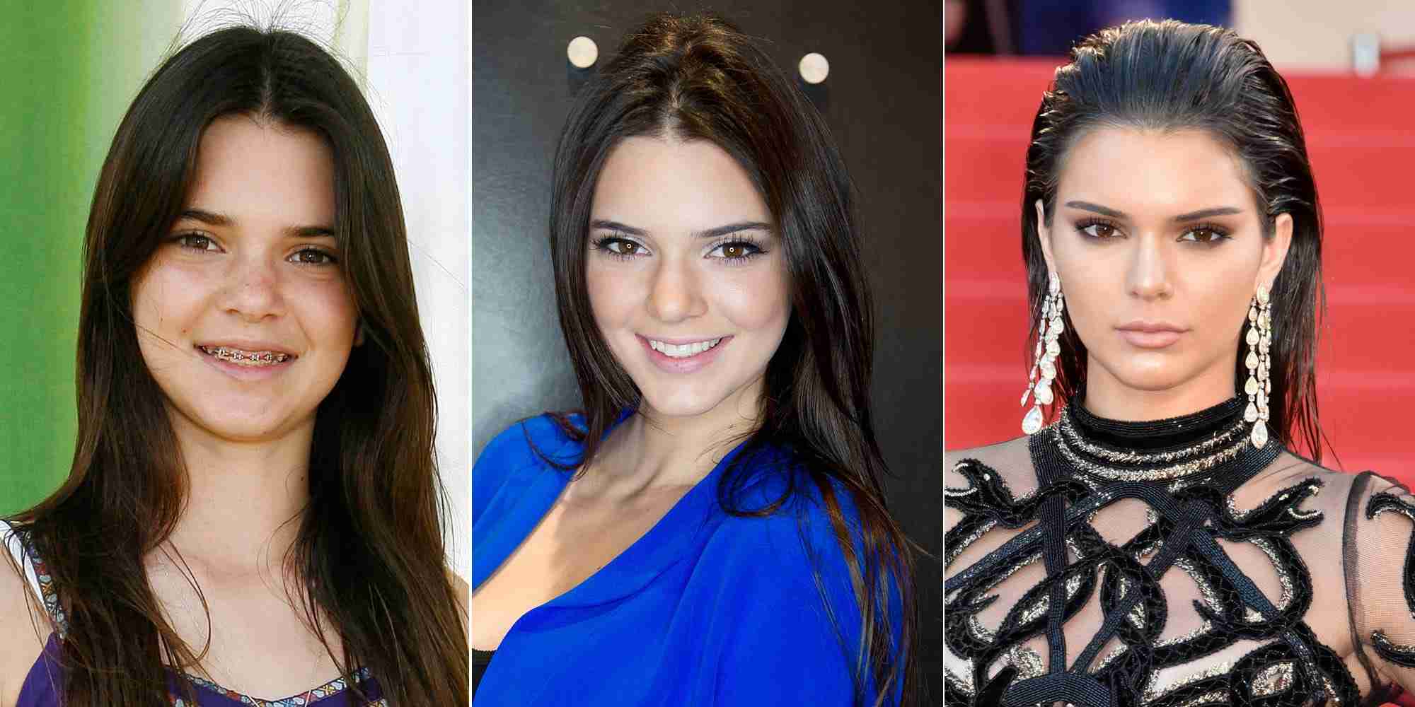 ケンダル・ジェンナー、整形完全否定で炎上「さすがに嘘」衝撃Before→After写真にSNS失笑&疑惑再燃