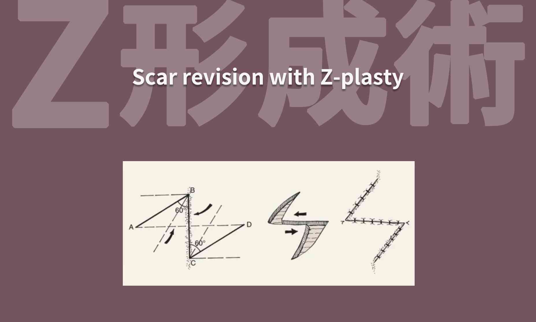 帝王切開のキズあとをきれいに治す方法～Z形成術 - 美容外科・美容皮膚科｜五本木クリニック