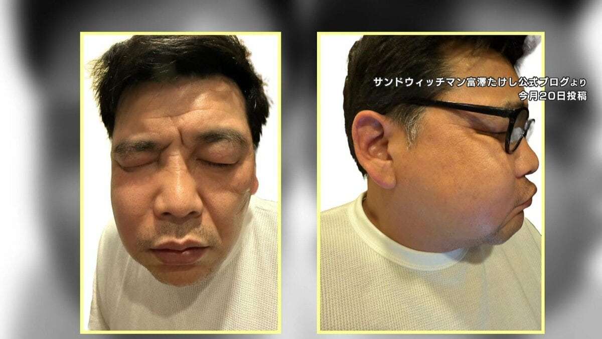 サンドウィッチマン・富澤たけし（50）顔が腫れ上がり痛々しい姿に…副鼻腔炎原因 花粉や黄砂でリスク上昇 | めざましmedia | “好き”でつながる
