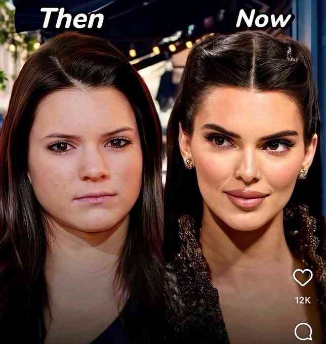 ケンダル・ジェンナー、整形完全否定で炎上「さすがに嘘」衝撃Before→After写真にSNS失笑&疑惑再燃