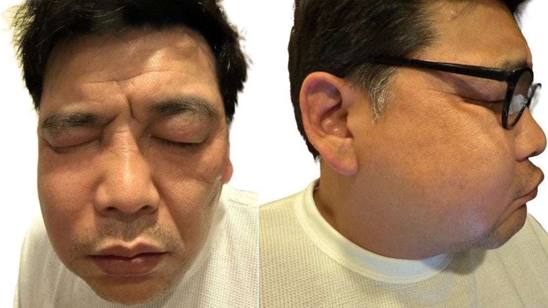【経験談求む】顔が腫れ上がって別人みたいになった