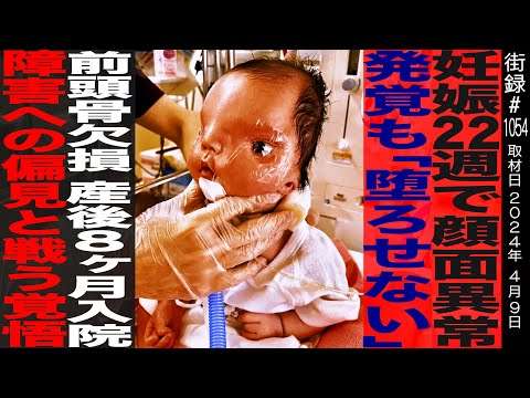 【後編】妊娠22週で顔面異常発覚も「堕ろせない」/前頭骨欠損 産後8ヶ月入院/ 障害への偏見と戦う覚悟/星のミライChannel