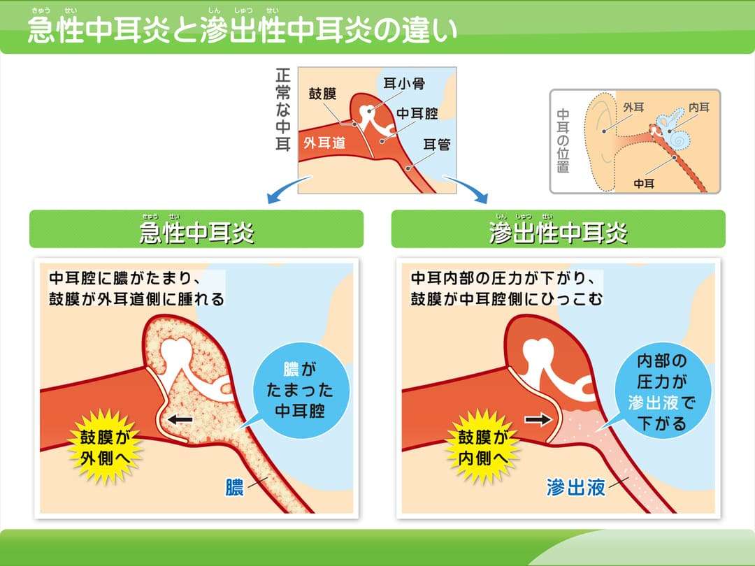 滲出性中耳炎が治らない