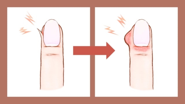 子供の爪むしり