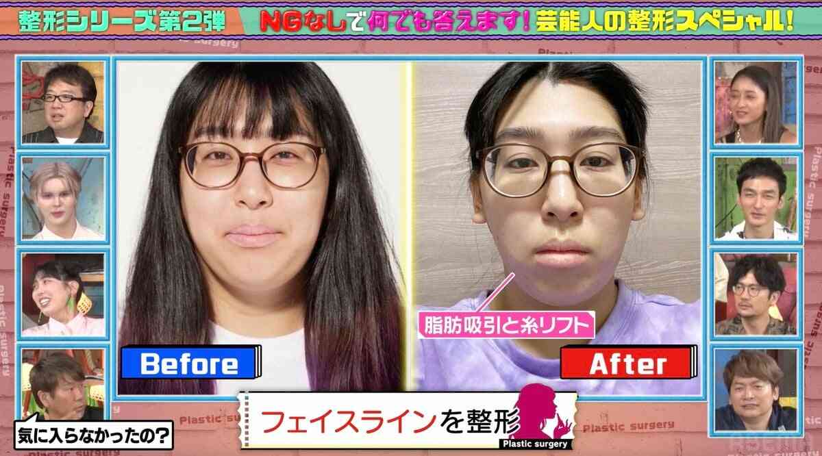 ゆめっち「さすがに変だよって言われたので」抜きすぎたフェイスラインの脂肪を再び戻す