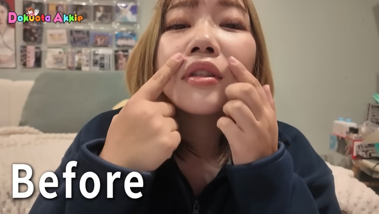 登録者70万人超の女性YouTuber、鼻の整形手術で「めっちゃ満足」 ファン反響「かわいい系から綺麗系に」