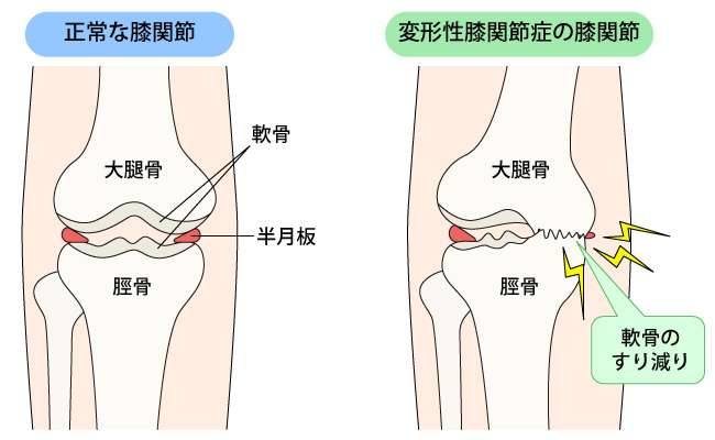 変形性膝関節症