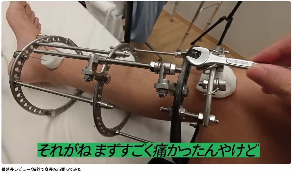 「1000万円で身長を買った」人気YouTuber、骨延長手術で7cm増も“無意識の過食”と“記憶障害”の壮絶リハビリ