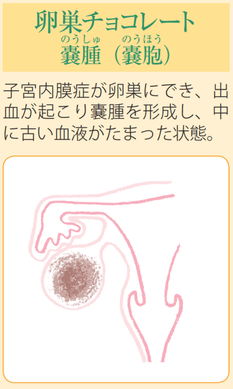 チョコレート嚢胞手術したことある方