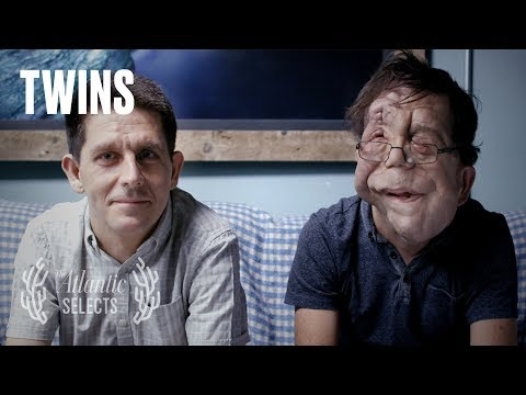 Identical Twins Who Look Nothing Alike