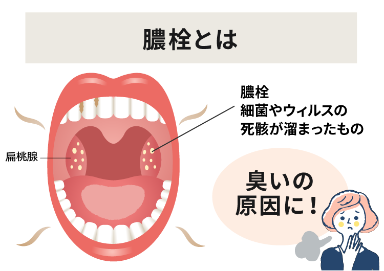 膿栓(臭い玉)