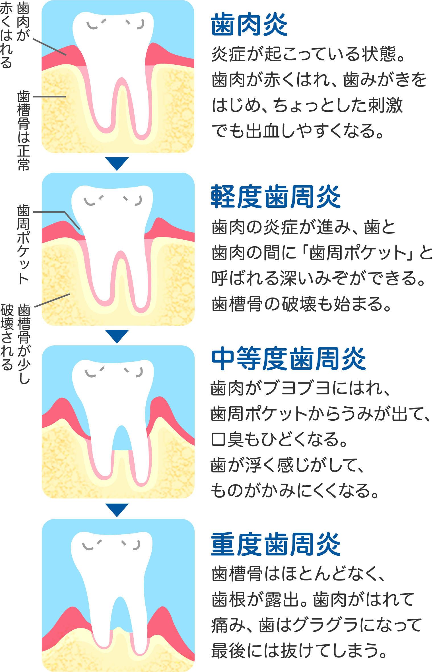 歯肉炎、歯周病を語りたい