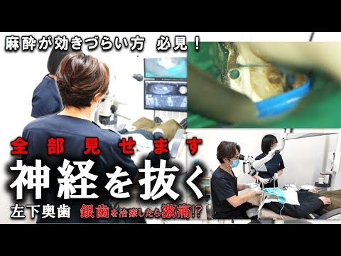 【全部見せます】銀歯を治療したら激痛？30分ノーカット治療の様子