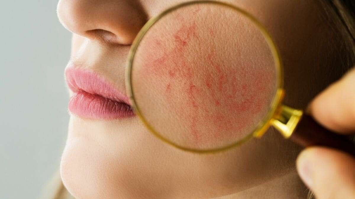｢赤ら顔で病院に駆け込む女性｣が増加中…皮膚科専門医が警鐘を鳴らす｢肌をボロボロにする化粧水｣の正体 美肌を目指せば目指すほど泥沼化する | PRESIDENT Online（プレジデントオンライン）