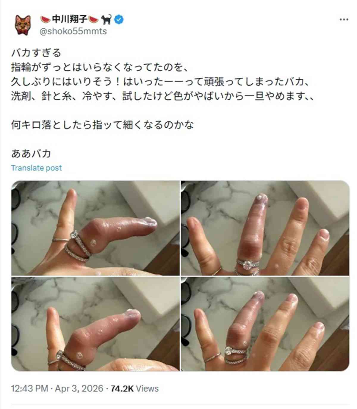 中川翔子「指輪が抜けない」パンパンに腫れた指の写真をアップし大炎上「早く病院行けばいいのに」アピールに顰蹙