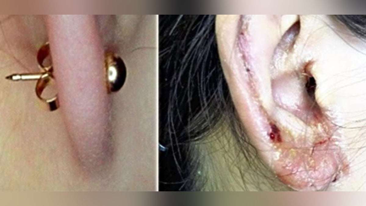 ピアスがきっかけの金属アレルギー、女性患者の半数を占めるまでに…徳島大病院の細木真紀教授「せめて成分表示の義務化を」 : 読売新聞