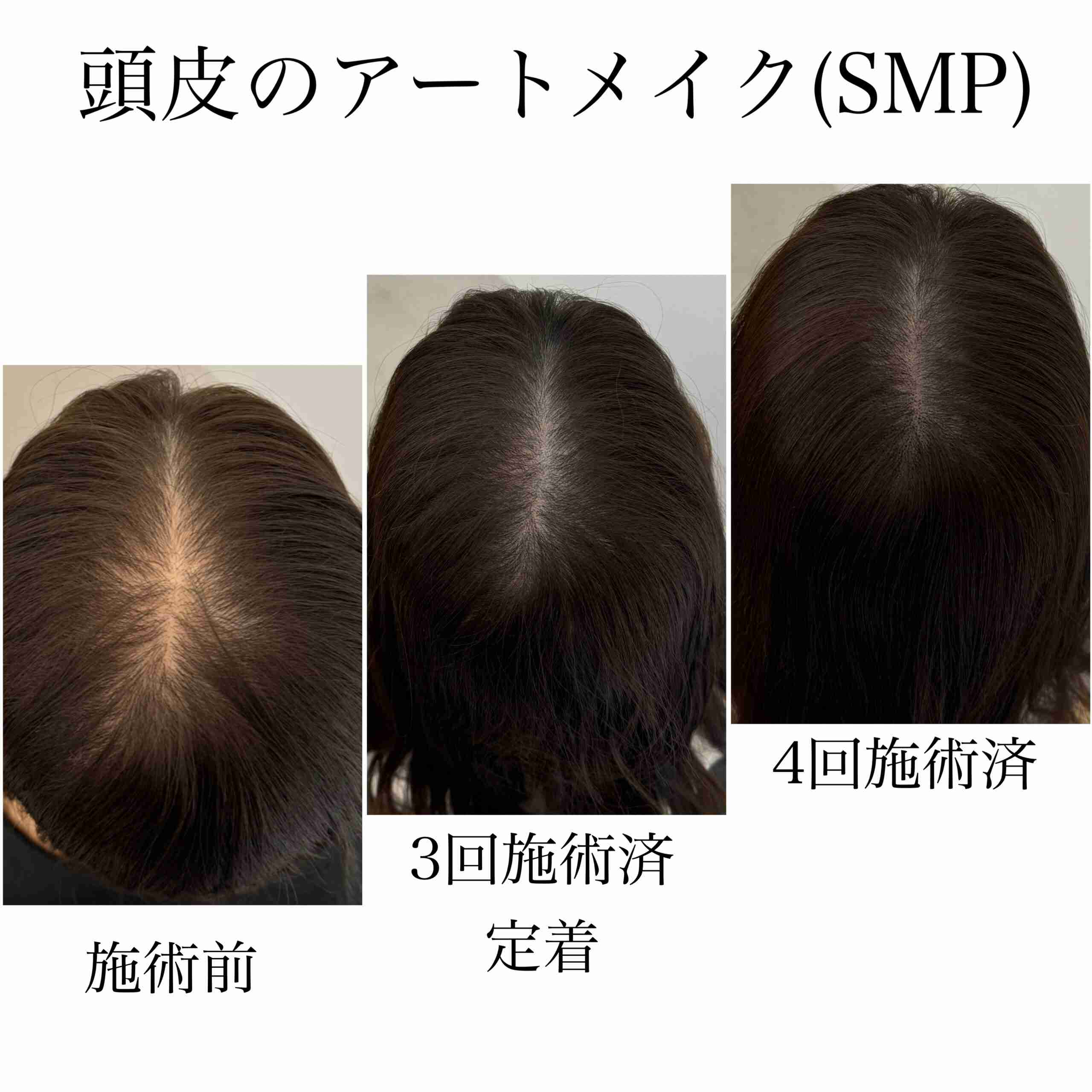 頭皮アートメイクについて