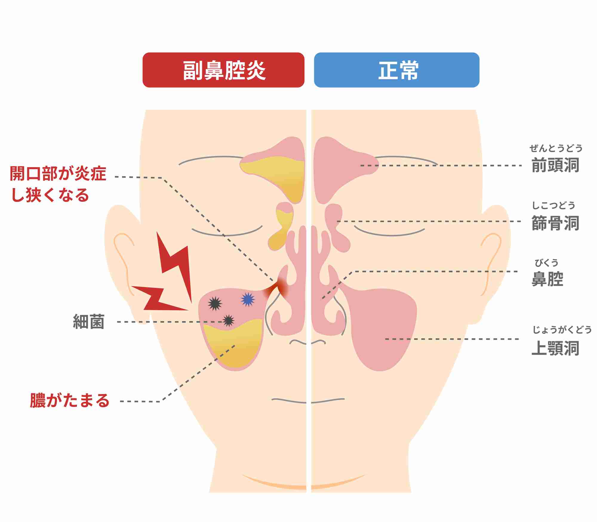 副鼻腔炎が治らない