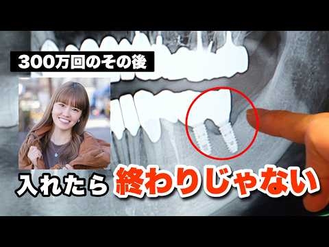 インプラントの寿命は“その後”で変わる。なぜメンテナンスが必要なのか