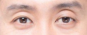上まぶたが窪んできた！