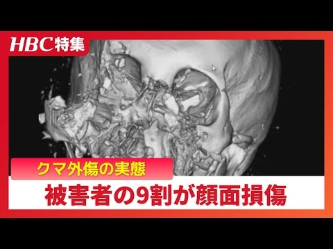 被害者の9割が顔面損傷…鼻がなくなり骨は粉砕「体を大きく見せようと立ち上がって…」医師が語るクマ外傷の実態　47歳男性はあの日を境に人生が一変
