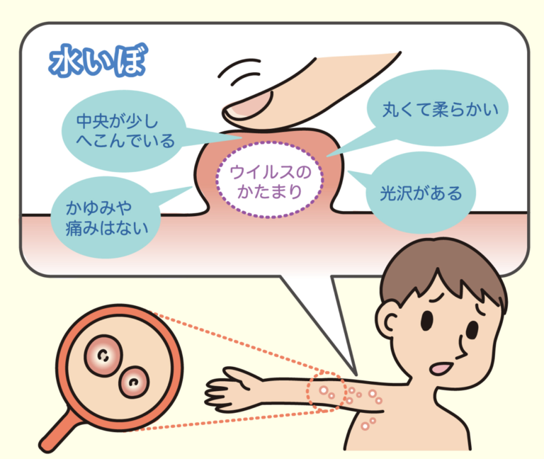 子供の水イボが治らない