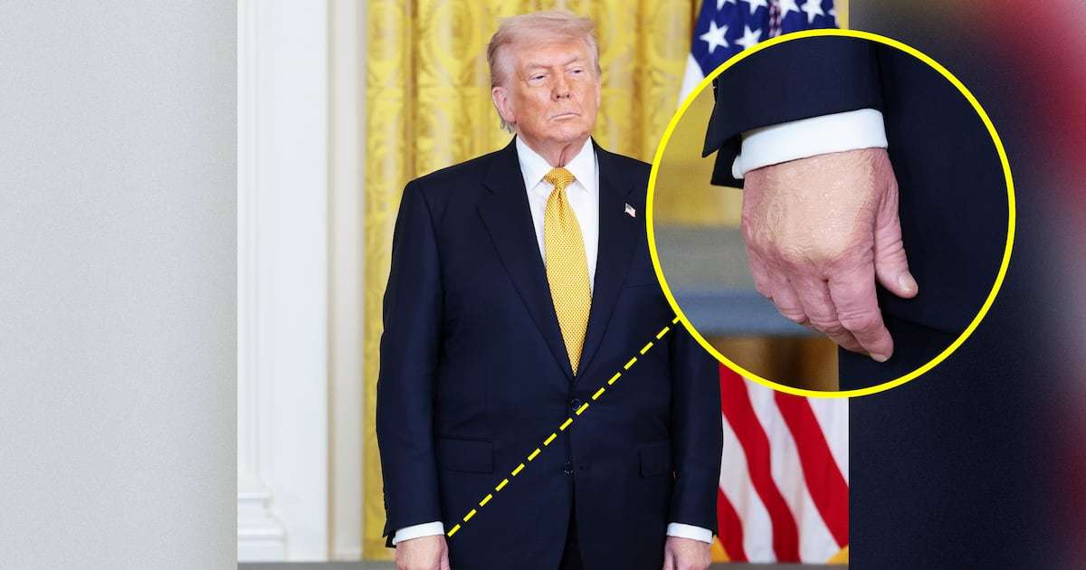 Trump, 79, Debuts Swollen Hands as Health Concerns Mount