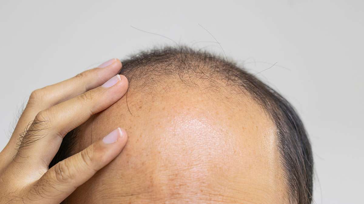 人はなぜかくも毛に執着するのか　脱毛も薄毛対策も巨大ビジネス　なぜか嫌われるわき毛やすね毛　猛暑に短パンでの職務は可能か | ヨミドクター(読売新聞)