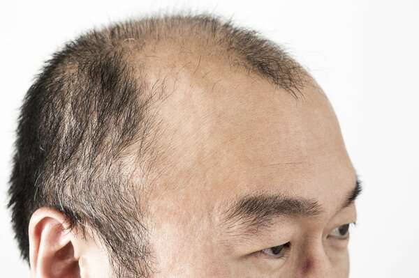 AGA発症には「母方の祖父」の薄毛が影響大　父親がフサフサでも油断できない…「母方の曽祖父」も薄毛でさらに高確率に｜FNNプライムオンライン