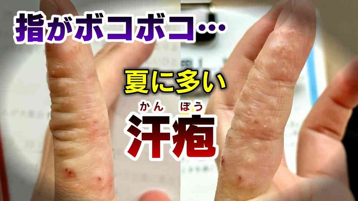 気がつくと指がボコボコに…1本の指に数十個の“水ぶくれ” 夏に増える「汗疱(かんぽう）」とは？ 水虫との違いや予防策を医師が解説 | TBS NEWS DIG