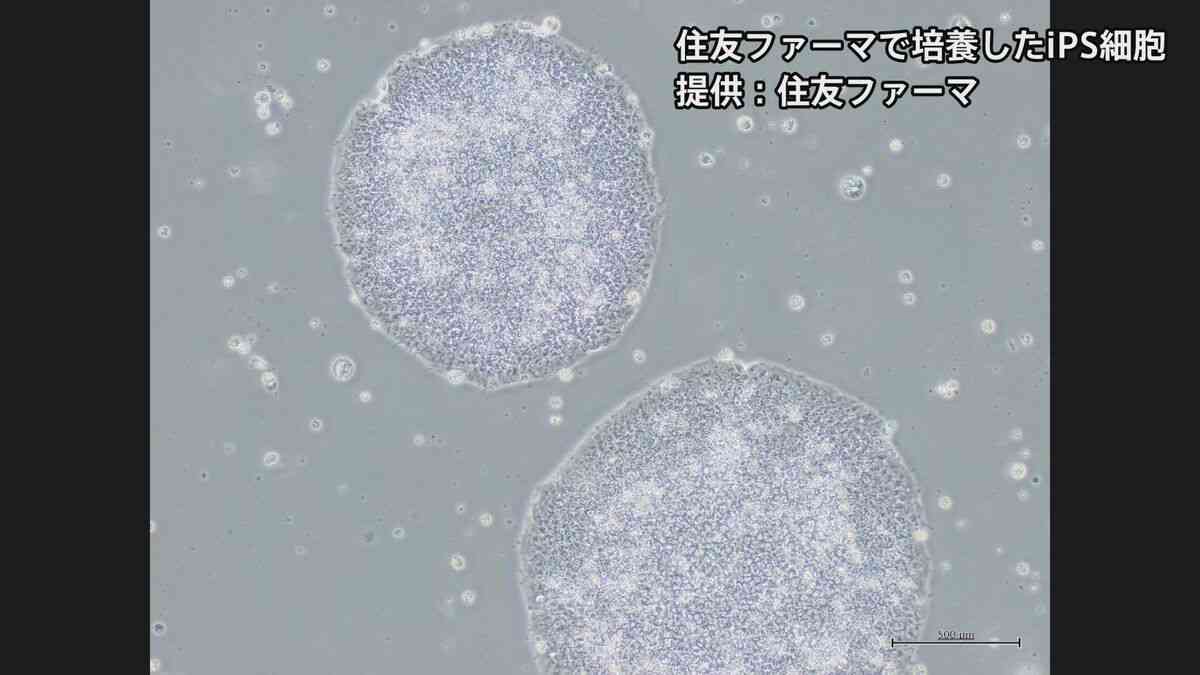 【速報】iPS細胞使ったパーキンソン病患者の再生医療製品「アムシェプリ」 公的医療保険の適用を了承 価格は約5530万円 中医協　 | TBS NEWS DIG