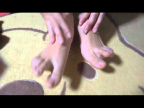 子宮頸がんワクチンの副作用１