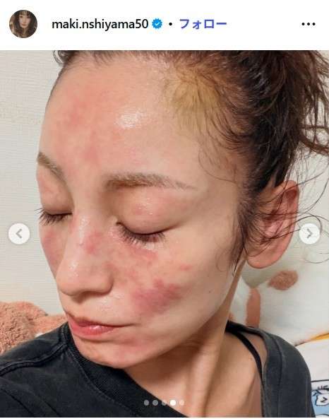 西山茉希(40)　極度の肌荒れで真っ赤になったスッピン公開「鏡を見たくない」 皮膚科でも原因特定できず