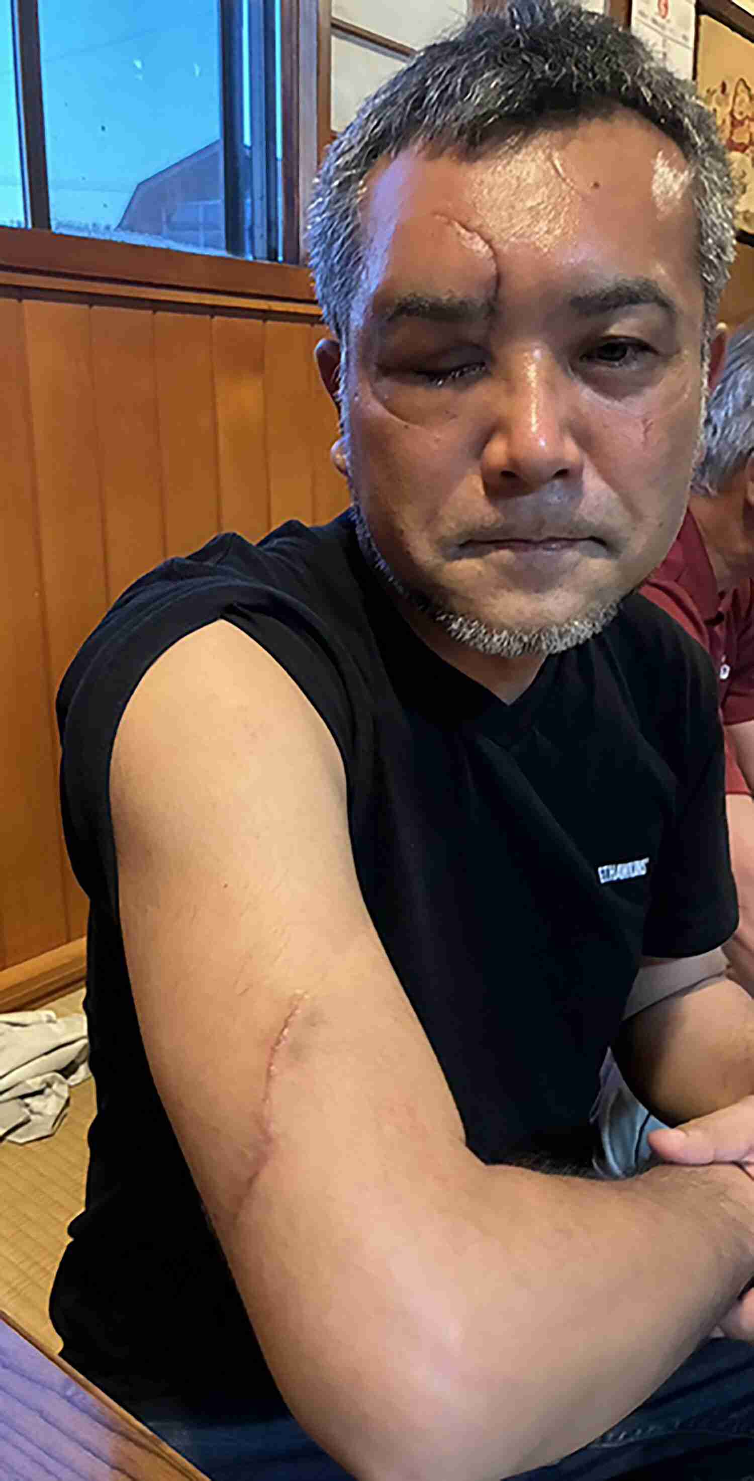 「医者に『脳は大丈夫』と言われたが眼球は破裂して…」農作業中にスコップで応戦→クマに襲われ負傷した男性の“その後”