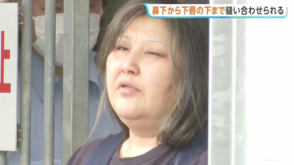 鼻の下から下唇の下までを口の中に糸を通す形で縫われる　女性の唇を縫い付け49歳女が逮捕された事件　茨城・古河市 | TBS NEWS DIG (1ページ)