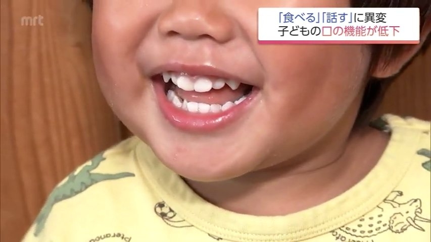 お口がぽかん 子どもの口腔機能発達不全症が全国で増加 昔ながらの遊び減少も原因に