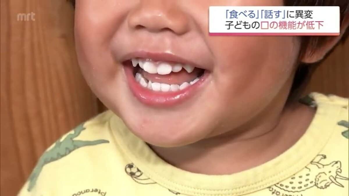 お口がぽかん  子どもの口腔機能発達不全症が全国で増加 昔ながらの遊び減少も原因に | MRTニュース ｜ ＭＲＴ宮崎放送
