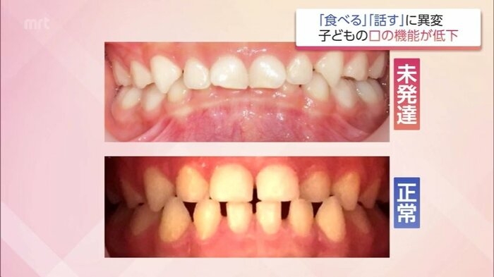 お口がぽかん 子どもの口腔機能発達不全症が全国で増加 昔ながらの遊び減少も原因に