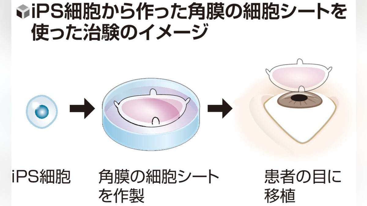 角膜上皮幹細胞疲弊症の患者対象にｉＰＳ角膜の治験開始、２０２８年にも承認を国に申請…大阪大発新興企業「レイメイ」 : 読売新聞