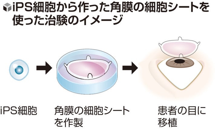 iPS角膜の治験開始、2028年にも承認を国に申請…大阪大発新興企業「レイメイ」