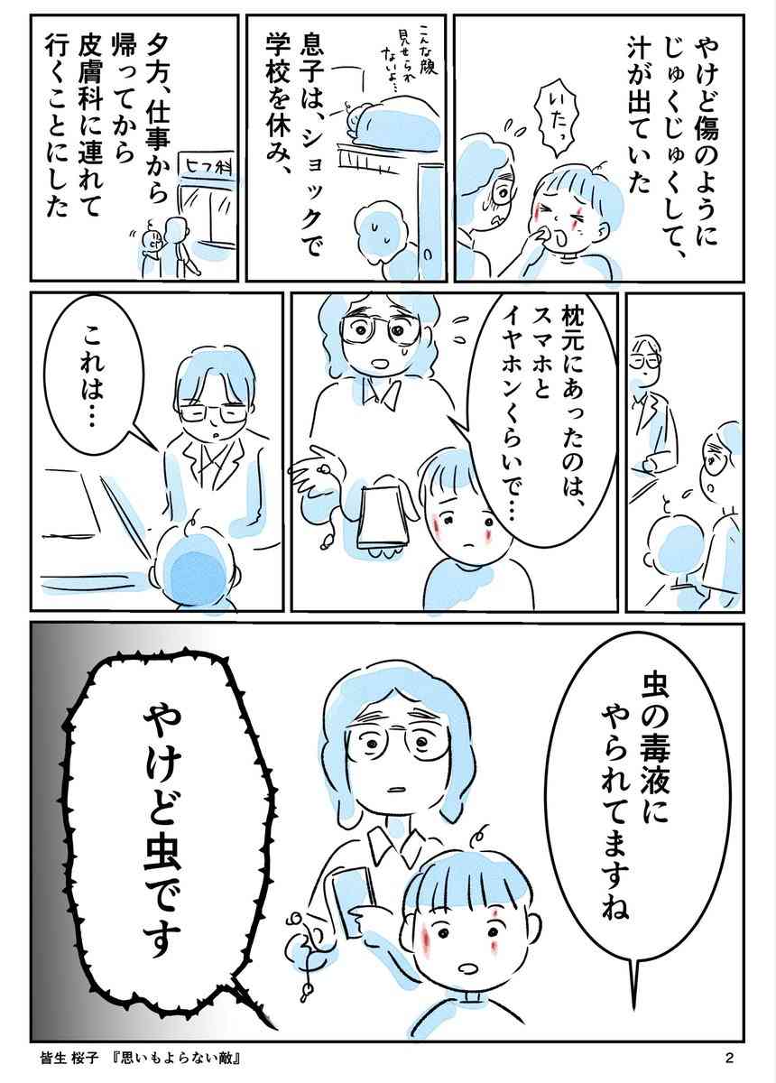 「息子に何が起きたのか…」ある朝、いつものように中学生の息子を起こしにいったら、顔に赤くただれた火傷のような跡が2本できていた話… ただれた箇所はじゅくじゅくしていて、 汁が出ていた
