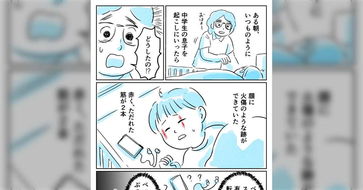 「息子に何が起きたのか…」ある朝、いつものように中学生の息子を起こしにいったら、顔に赤くただれた火傷のような跡が2本できていた話… ただれた箇所はじゅくじゅくしていて、 汁が出ていた - Togetter