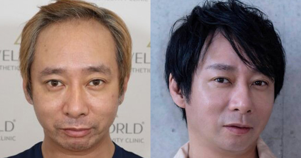《「ハゲ」「キモい」と言われ…》いしだ壱成　薄毛で芸能界引退、うつ・離婚も…植毛で取り戻した自信「ここからが第二の人生」 | 女性自身